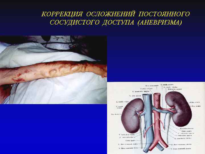 КОРРЕКЦИЯ ОСЛОЖНЕНИЙ ПОСТОЯННОГО СОСУДИСТОГО ДОСТУПА (АНЕВРИЗМА) 