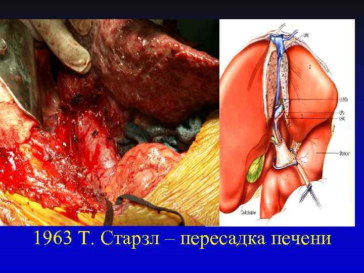 1963 Т. Старзл – пересадка печени 