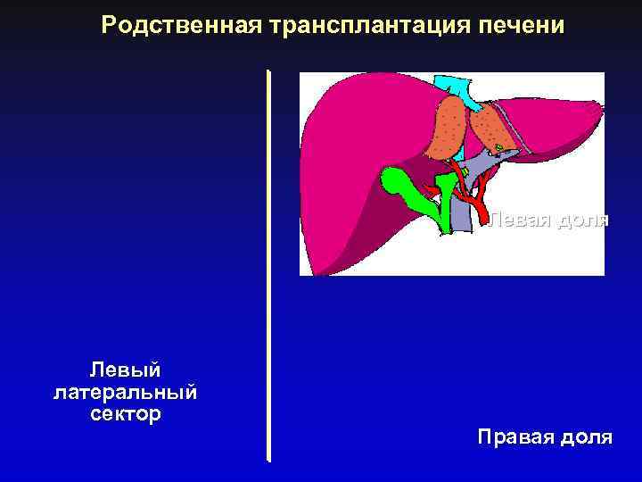 Родственная трансплантация печени Левая доля Левый латеральный сектор Правая доля 