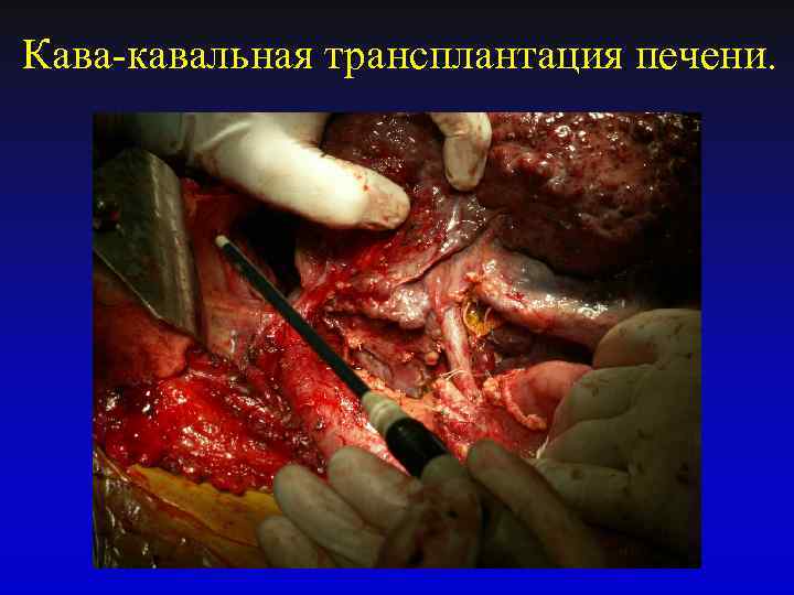 Кава-кавальная трансплантация печени. 