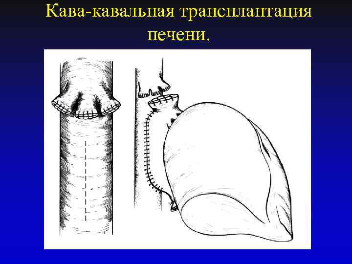 Кава-кавальная трансплантация печени. 