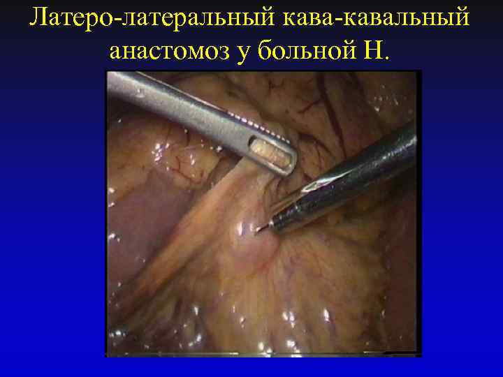 Латеро-латеральный кава-кавальный анастомоз у больной Н. 