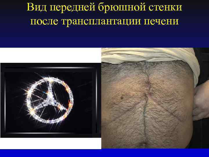 Вид передней брюшной стенки после трансплантации печени 