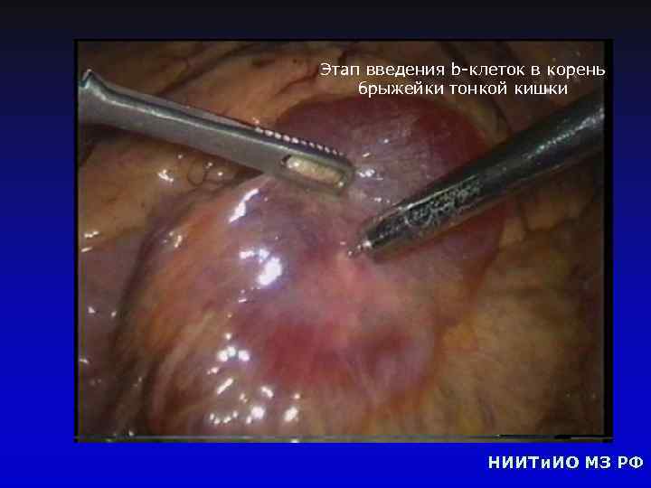 Этап введения b-клеток в корень брыжейки тонкой кишки НИИТи. ИО МЗ РФ 