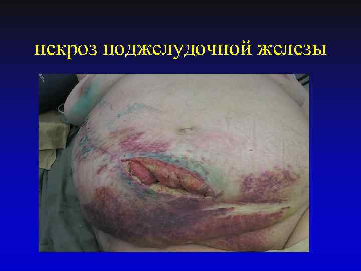 некроз поджелудочной железы 
