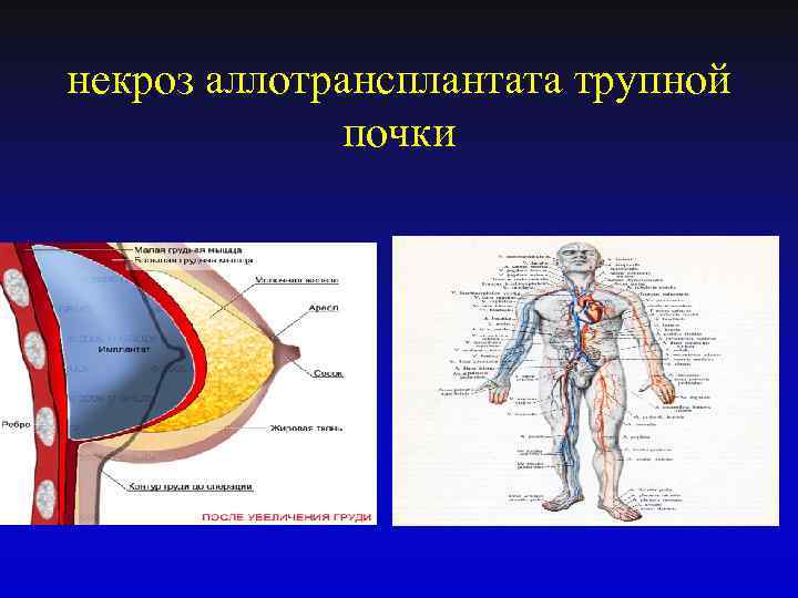некроз аллотрансплантата трупной почки 