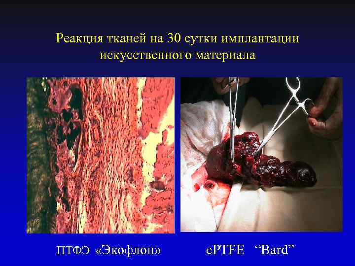 Реакция тканей на 30 сутки имплантации искусственного материала ПТФЭ «Экофлон» e. PTFE “Bard” 