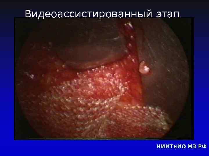 Видеоассистированный этап НИИТи. ИО МЗ РФ 