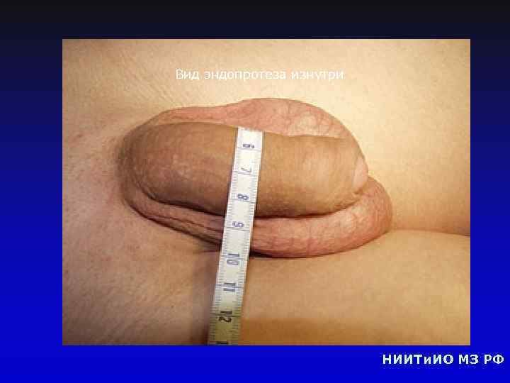 Вид эндопротеза изнутри НИИТи. ИО МЗ РФ 