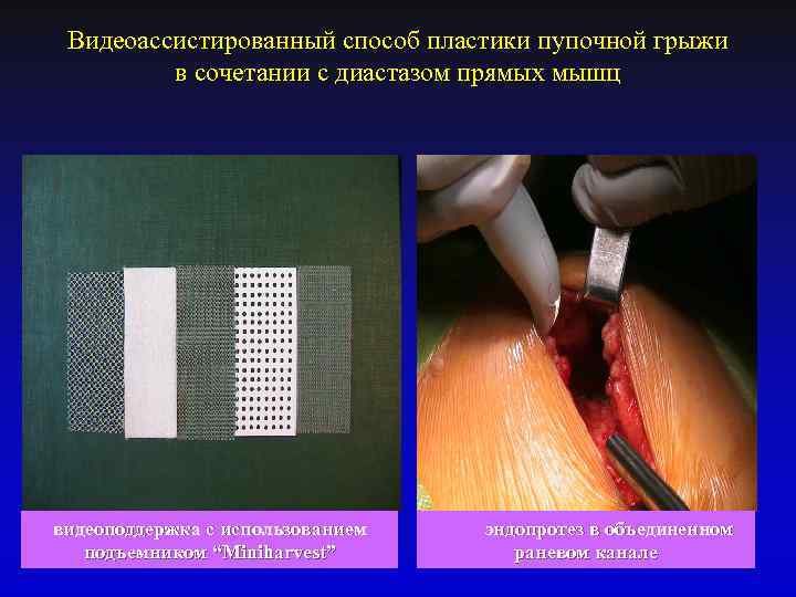 Видеоассистированный способ пластики пупочной грыжи в сочетании с диастазом прямых мышц видеоподдержка с использованием