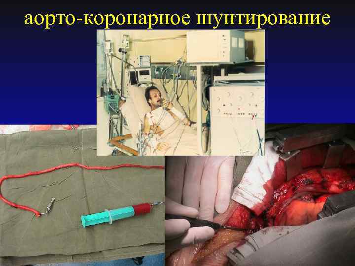 аорто-коронарное шунтирование 