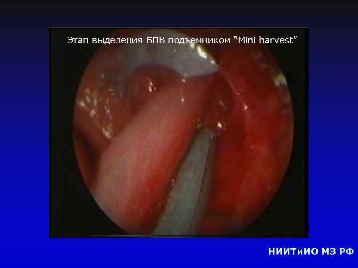 Этап выделения БПВ подъемником “Mini harvest” НИИТи. ИО МЗ РФ 