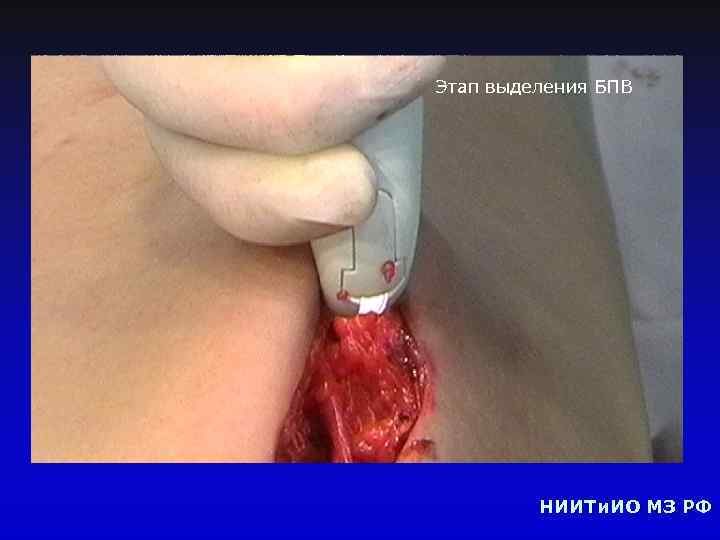 Этап выделения БПВ НИИТи. ИО МЗ РФ 