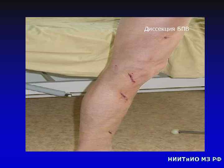 Диссекция БПВ НИИТи. ИО МЗ РФ 