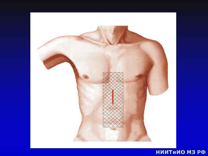 Вид нижней конечности (эндохирургический забор) НИИТи. ИО МЗ РФ 