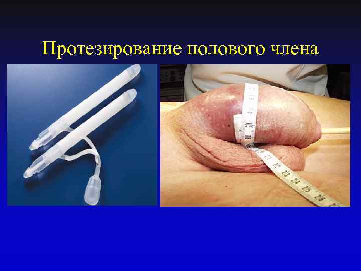 Протезирование полового члена 