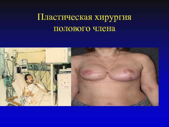 Пластическая хирургия полового члена 