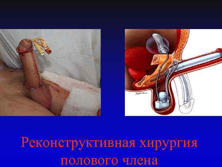 Реконструктивная хирургия полового члена 