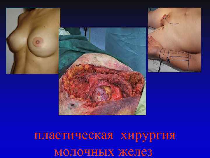  пластическая хирургия молочных желез 