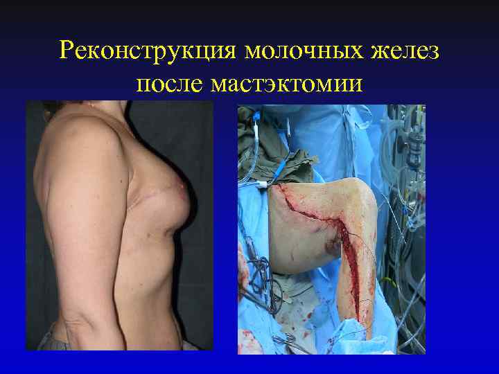 Реконструкция молочных желез после мастэктомии 