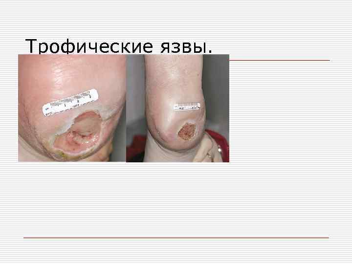 Трофические язвы. 