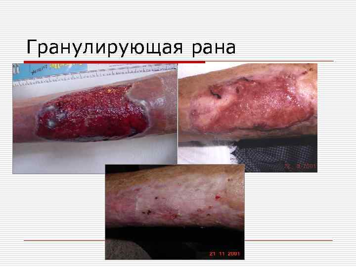 Гранулирующая рана 