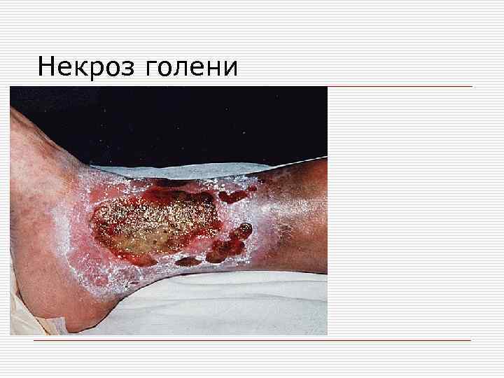 Некроз голени 