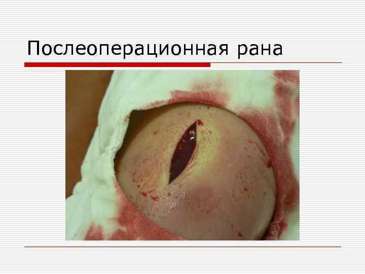 Послеоперационная рана 