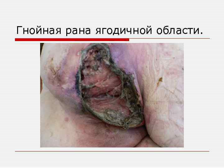 Гнойная рана ягодичной области. 