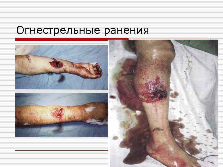 Огнестрельные ранения 