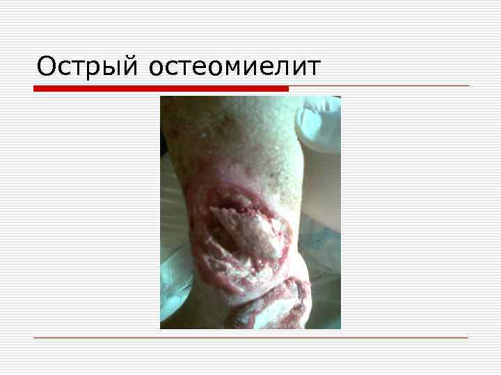 Острый остеомиелит 