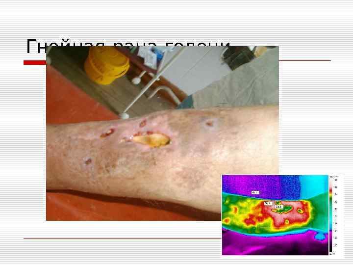 Гнойная рана голени 