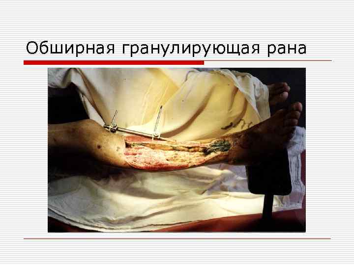 Обширная гранулирующая рана 