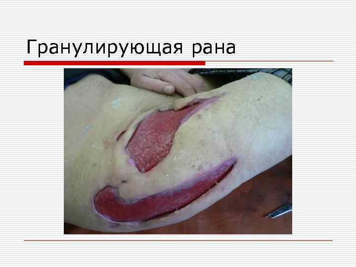 Гранулирующая рана 