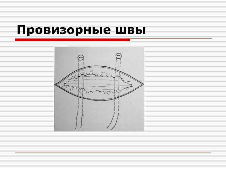 Провизорные швы 