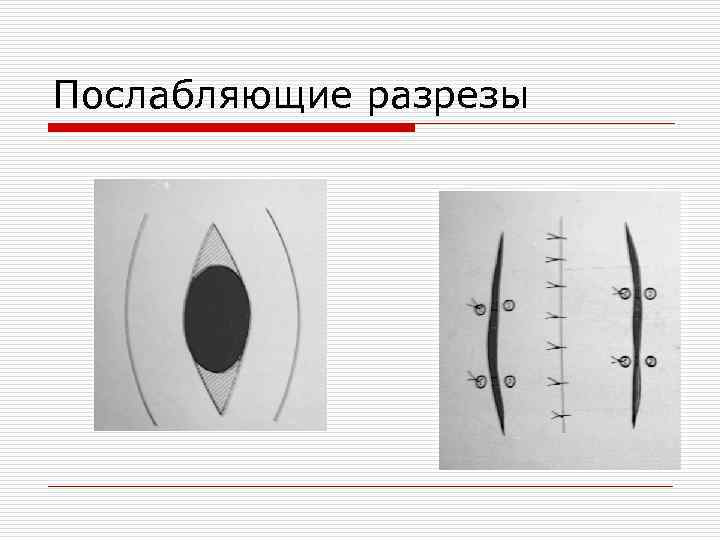 Презентация пластика местными тканями