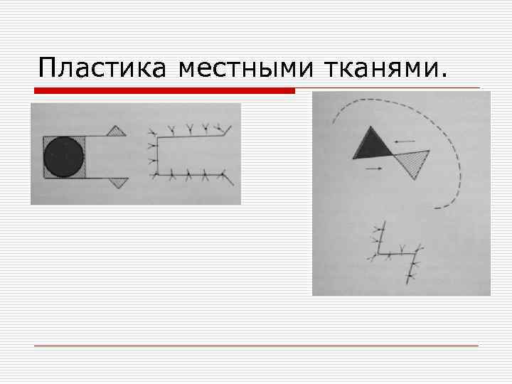 Пластика местными тканями. 