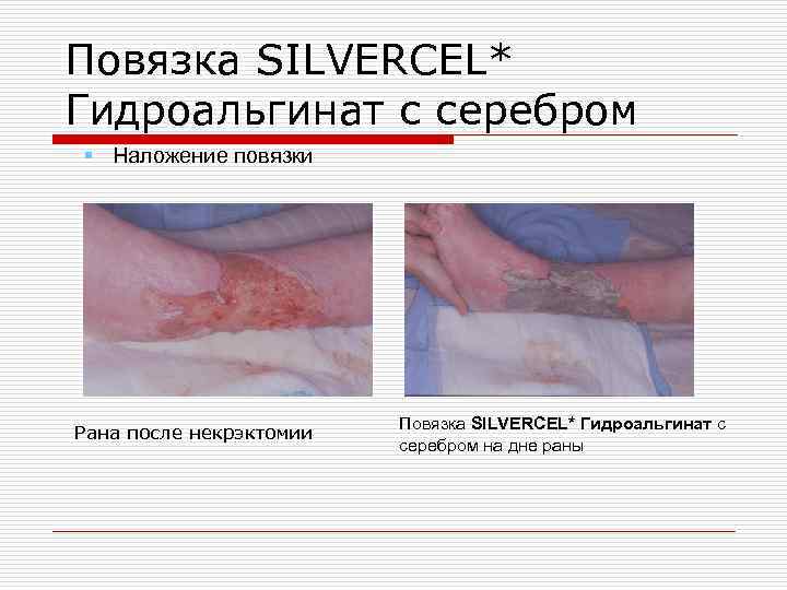 Повязка SILVERCEL* Гидроальгинат с серебром § Наложение повязки Рана после некрэктомии Повязка SILVERCEL* Гидроальгинат