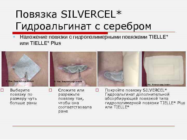 Повязка SILVERCEL* Гидроальгинат с серебром § Наложение повязки с гидрополимерными повязками TIELLE* или TIELLE*