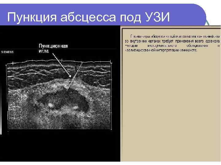 Пункция абсцесса под УЗИ 