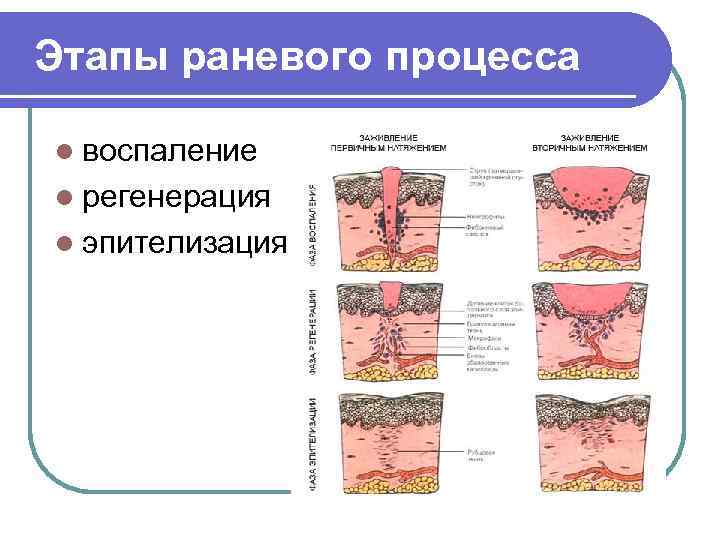  Этапы раневого процесса l воспаление l регенерация l эпителизация 