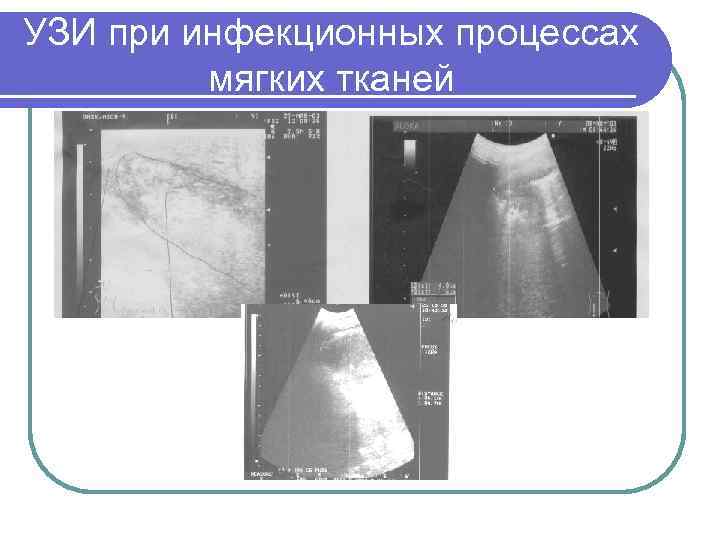 УЗИ при инфекционных процессах мягких тканей 