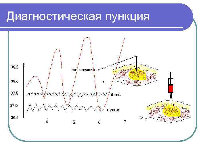 Диагностическая пункция 