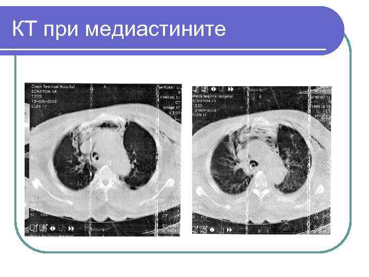 КТ при медиастините 