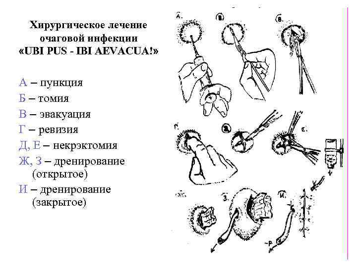 Хирургическое лечение очаговой инфекции «UBI PUS - IBI AEVACUA!» А – пункция Б –