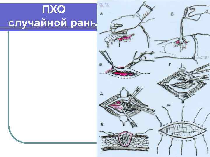 Первичная обработка ран. Этапы первичной хирургической обработки РАН. Вторичная хирургическая обработка РАН этапы. Схема первичной хирургической обработки раны. Первая хирургическая обработка раны.