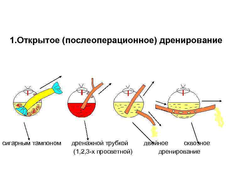 Техника дренирования полостей 1. Открытое (послеоперационное) дренирование сигарным тампоном дренажной трубкой двойное сквозное (1,