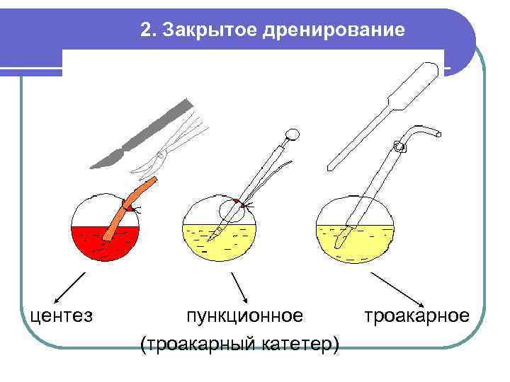  2. Закрытое дренирование центез пункционное троакарное (троакарный катетер) 