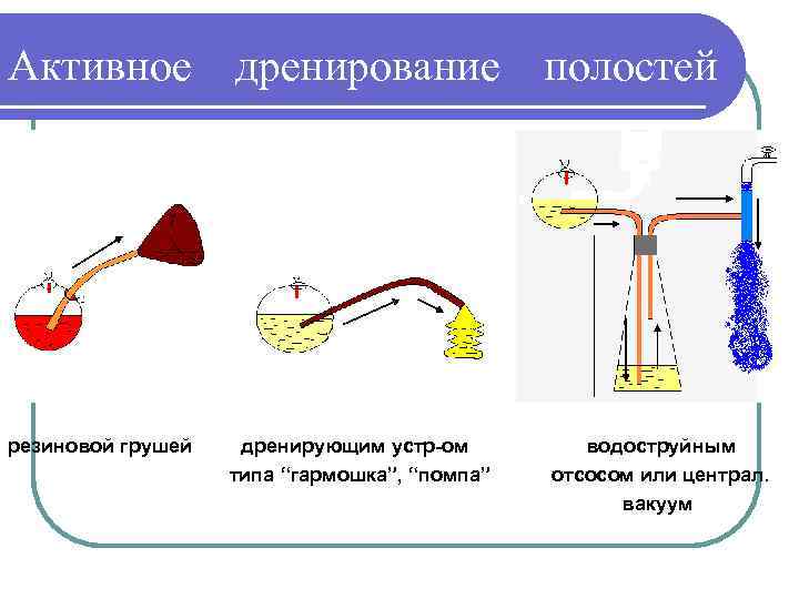 Активное дренирование полостей резиновой грушей дренирующим устр-ом типа “гармошка”, “помпа” водоструйным отсосом или централ.