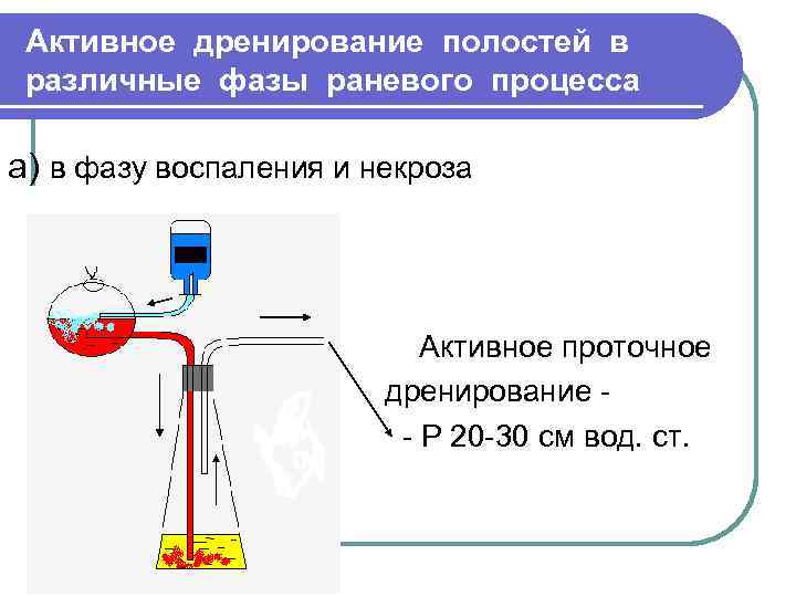 Активное дренирование полостей в различные фазы раневого процесса а) в фазу воспаления и некроза